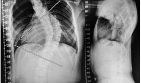 安顺市人民医院脊柱外科团队助力12岁花季少女挺直脊梁