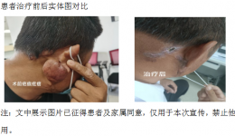 疤痕疙瘩防卫战——安顺市人民医院肿瘤科一病区成功实施首例疤痕疙瘩术后放疗