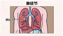 肺腑之言|一文教你看懂胸部體檢CT報告單