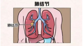 肺腑之言|一文教你看懂胸部体检CT报告单