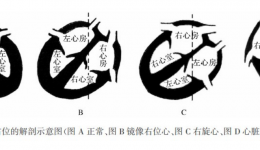 安順市人民醫(yī)院PICC門診在B超引導(dǎo)下用改良賽丁格技術(shù)完成首例“鏡面人”置管