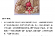 颅内动脉瘤的护理常规