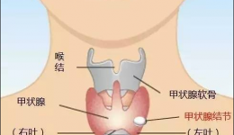 科普｜甲狀腺結(jié)節(jié)之健康認(rèn)識